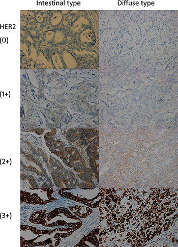 HER2 immunohistochemistry of gastric cancer tissues stratified by scores and Laur&#x00E9;n classification.