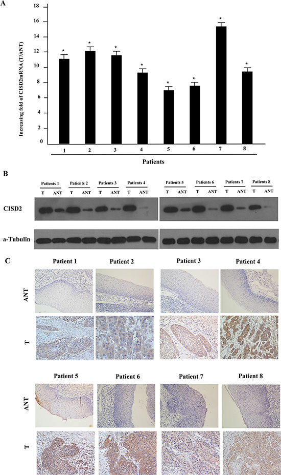 Overexpression of CISD2 mRNA and protein in human laryngeal squamous cell carcinoma (LSCC) tissues.