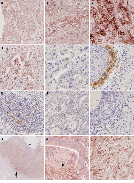 PD-L1 and PD-1 expression in gastric cancer and liver metastases.