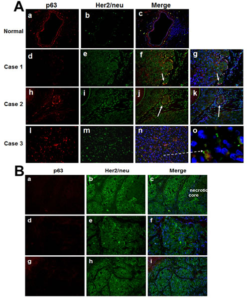 Immunofluorescence analysis of p63 and Her2/neu in clinical comedo-DCIS (A) and SUM-225 xenografts (B).