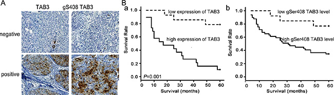 The TAB3 O-GlcNAcylation is correlated with the poorer prognosis in TNBC patients.