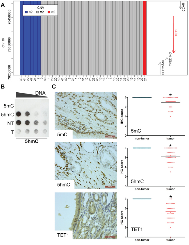 Reduced 5hmC and TET1 in prostate cancer.