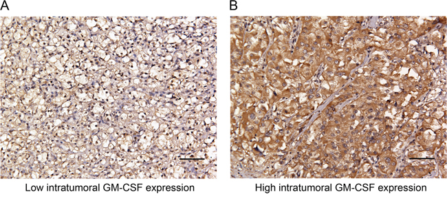 Representative photographs of intratumoral GM-CSF expression by immunostaining in clinically localized ccRCC.