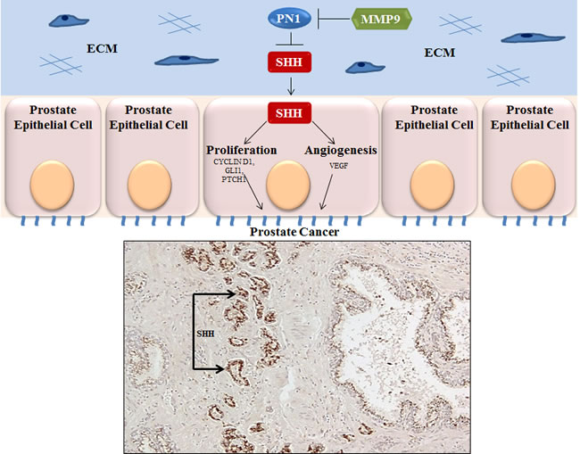 Expression of SHH in prostate cancer.