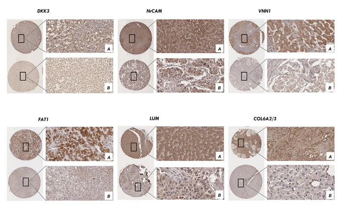 Validation of the candidates by immunohistochemistry in tissue microarray.