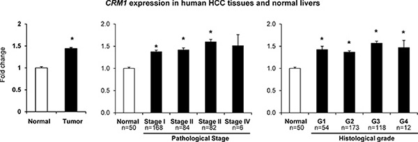 Expression of the CRM1 gene in human HCC samples.