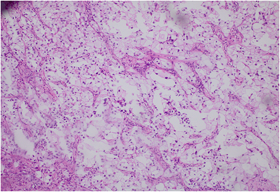 The representative image of lung adenocarcinoma with clear cell component.