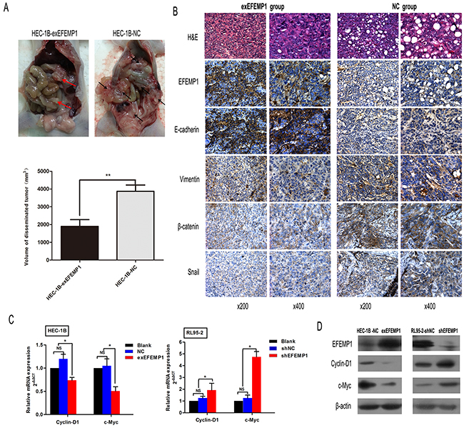 EFEMP1 downregulates the expression of target genes in the Wnt/&#x03B2;-catenin pathway and suppresses EMT in mice peritoneum metastasis model.
