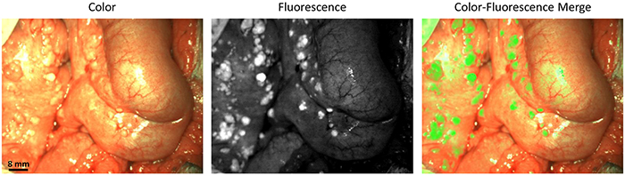 Identification of ovarian cancer metastases using fluorescence imaging.