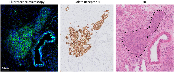 Histopathological evaluation of fluorescence signal in ovarian cancer.