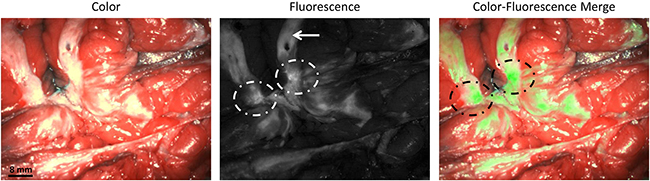 Identification of breast cancer metastases using fluorescence imaging.