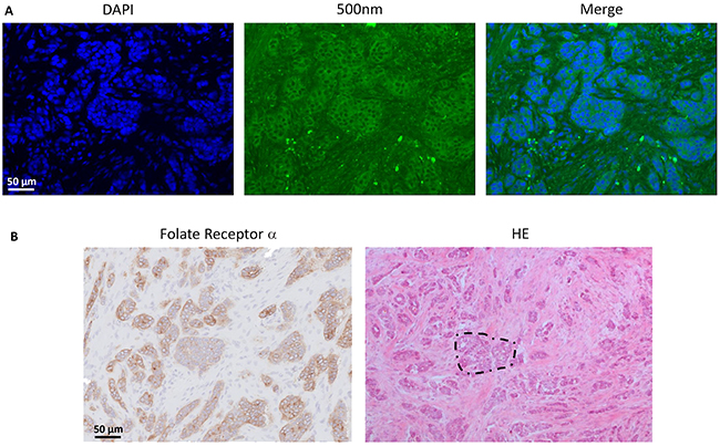 Histopathological evaluation of fluorescence signal in breast cancer.