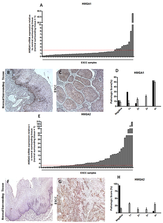 HMGA1 and HMGA2 mRNA and protein expression pattern in esophageal squamous cell carcinomas (ESCC).