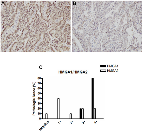 HMGA1 and HMGA2 protein expression pattern in esophageal adenocarcinoma (EAC) samples.