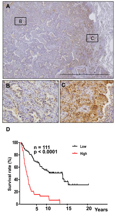 Overexpression of Crk at the invasion front of human lung cancer tissues.