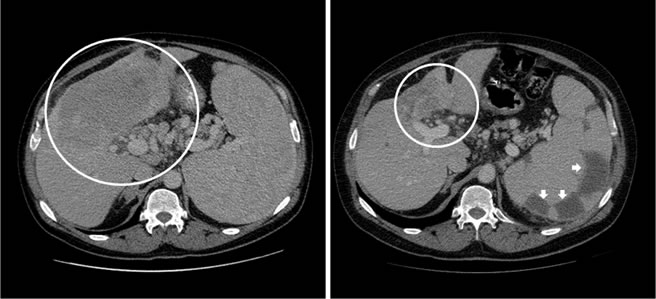 Prolonged partial response for 12.1 months noted in the primary hepatic lesion of a patient with advanced cholangiocarcinoma treated with hepatic arterial infusion of a cytotoxic agent along with intravenous anti-angiogenic agent.