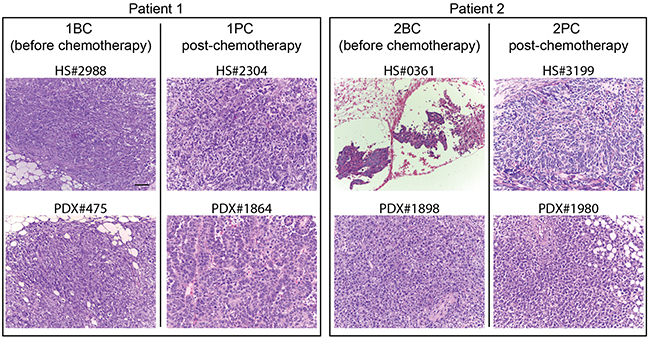 Histology of the originating tumors and the corresponding PDXs in xenopatients.