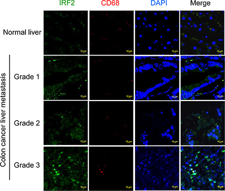 Up-regulation of IRF2 in metastatic liver tissue of colon cancer patients.