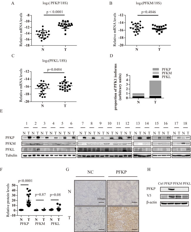 PFKP mRNA and protein is up-regulated in human ccRCC tissues.