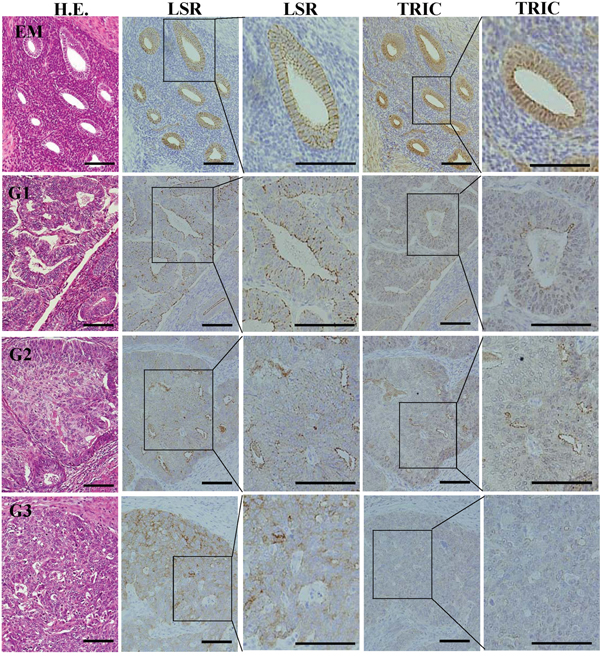Expression and localization of LSR and TRIC in the tissues of endometriosis and endometrial cancer.
