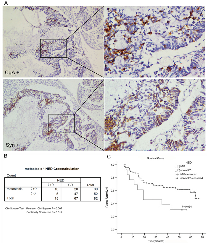 Neuroendocrine differentiation correlated with the poor prognosis of colorectal adenocarcinom.