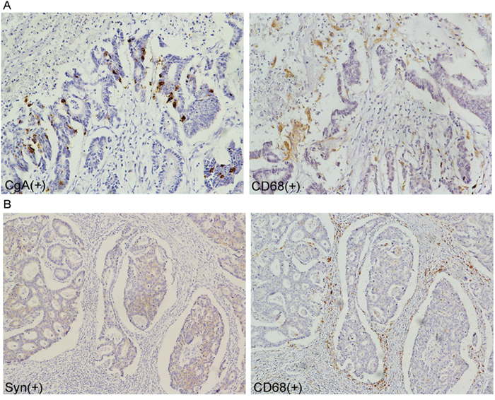 Correlation of neuroendocrine and tumor-associated macrophages in colorectal adenocarcinoma tissue.