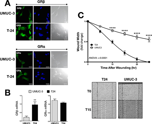 GR&#x03B2; and GR&#x03B1; expression and migration in UMUC3 and T24 human bladder cancer cells.