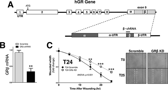 Knockdown of GR&#x03B2; reduces migration of human bladder cancer cells.