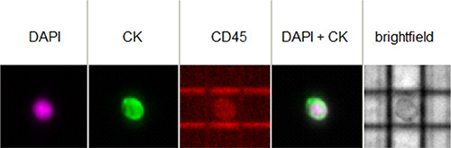 Image of a single CTC isolated from one patient as it appears in the image gallery of the DEPArray&#x2122; instrument.