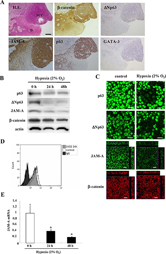 Images of H.E. and immunohistochemical staining (A) of JAM-A, &#x03B2;-catenin, p63, &#x0394;Np63 and GATA-3 in HNSCC and dysplastic regions.