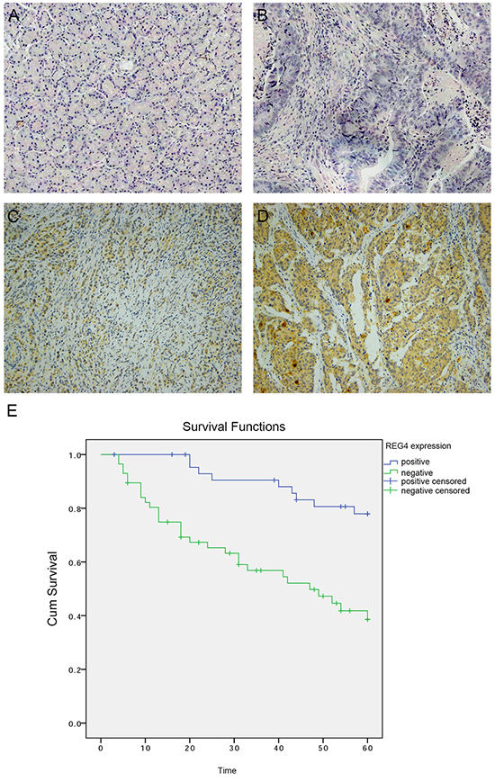 Expression of REG4 in clinical gastric cancer tissues.