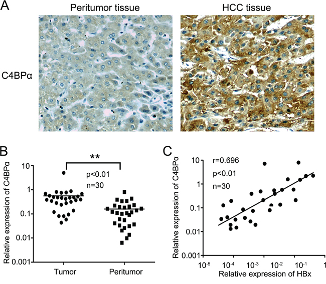 The expression levels of HBx are positively correlated with those of C4BP&alpha; in clinical HCC tissues.