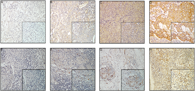 CTLA-4 expression in esophageal carcinoma samples.