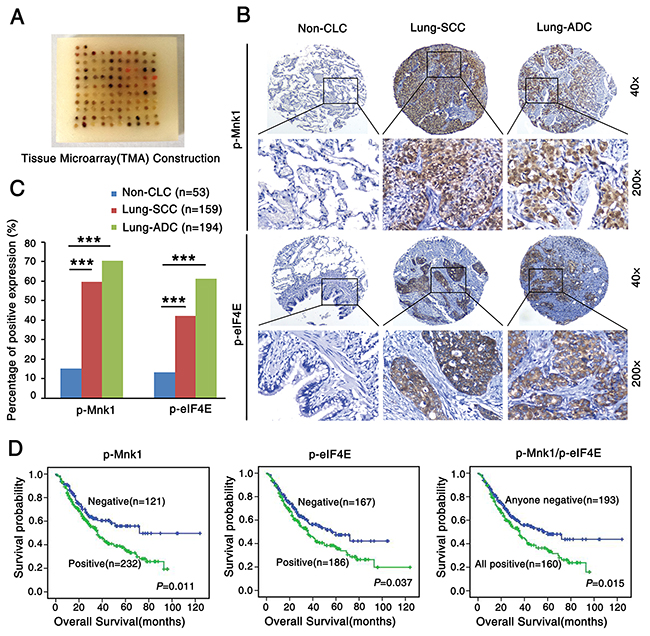 P-Mnk1 and p-eIF4E expression increases and correlates with poor prognosis in NSCLC.