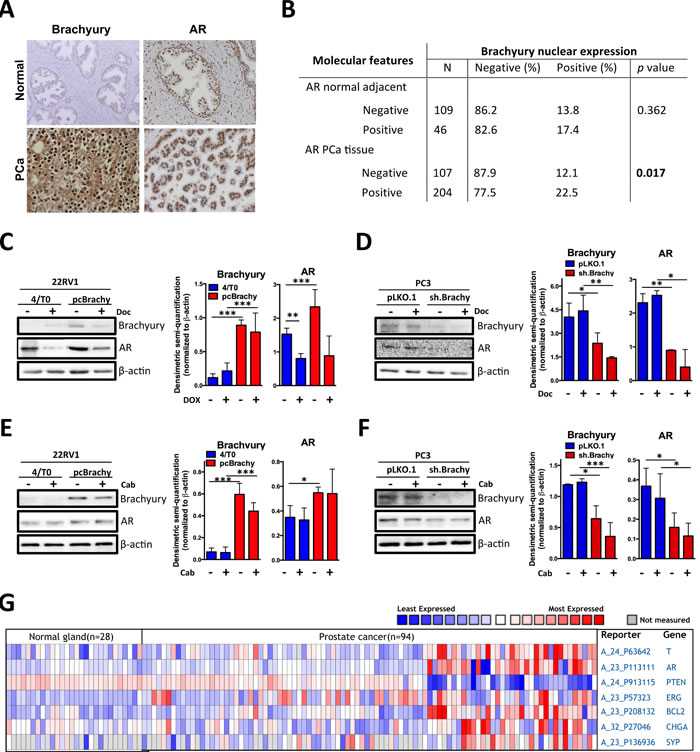 Brachyury is associated with AR, Bcl-2, ERG, CHGA and SYP expression and with loss of PTEN expression.