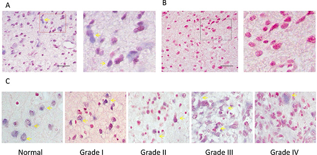 ISH analysis of miR-149 expression in normal brain tissue and in tissues of different grades of glioma carcinoma.