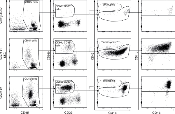 Gating strategies applied to analyze by flow cytometry PBMCs from healthy donors (top panel row) and lymphoma patients (middle and bottom panel row).
