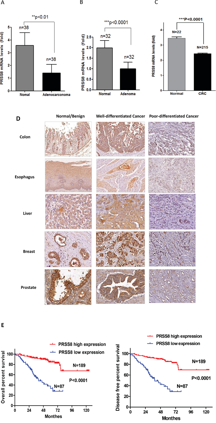PRSS8 expression levels were reduced in tumors and the reduction of PRSS8 was associated with poor differentiation and survival time.