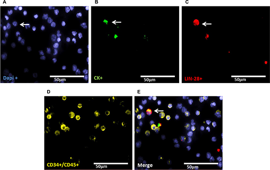 Representative four-fold immunofluorescence staining for CKpos/LIN-28pos cells after therapy of patient No1.