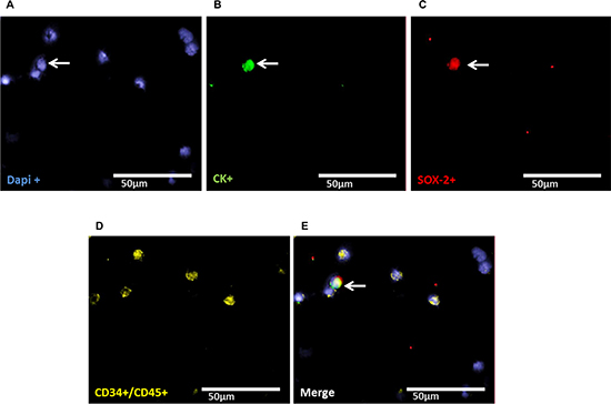 Representative four-fold immunofluorescence staining for CKpos/SOX-2pos cells after therapy of patient No1.