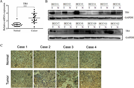 TR4 was up-regulated in tumor tissues among HCC patients.