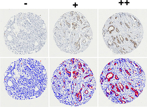 Representative tissue cores showing cytoplasmic staining that represents expression of IGFBP-2 in breast cancer.