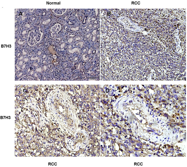 Immunohistochemical staining for B7-H3 in clinical specimens.