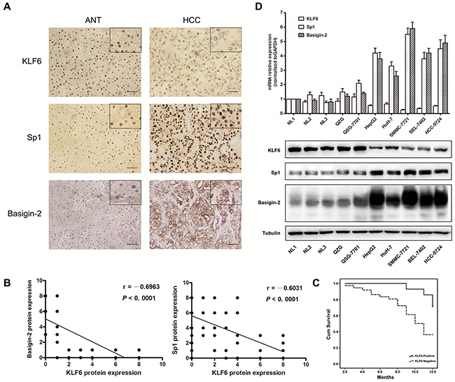 KLF6 is down-regulated in HCC tissues and cell lines.