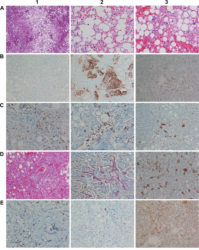 Histopathology and immunohistochemistry of liver tissue from a fulminant fatal case of acute liver failure after a single infusion of 10&#x03BC;g Catumaxomab.