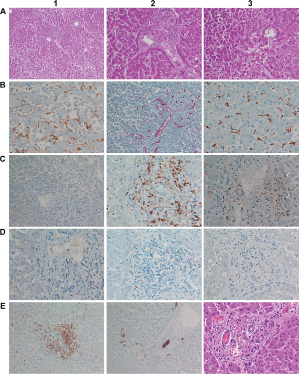 Histopathology and immunohistochemistry of liver tissue from a male patient after 11 consecutive infusions of 7&#x03BC;g Catumaxomab.