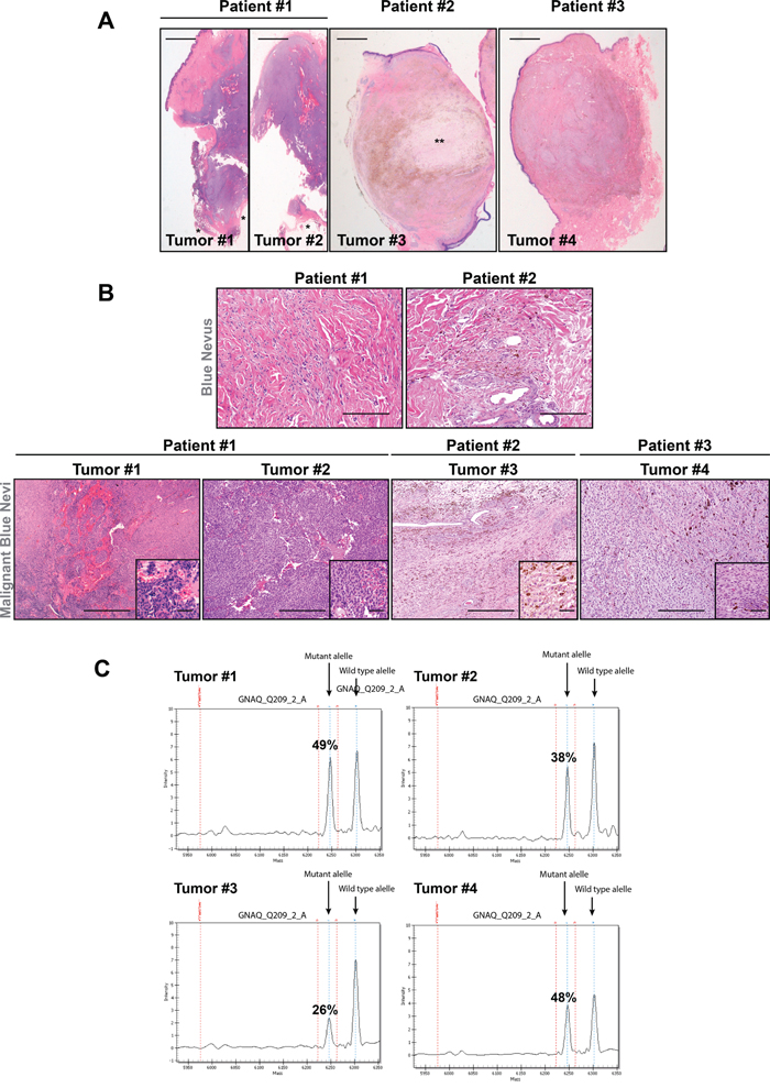 Histological description of GNAQ-mutated patient samples.