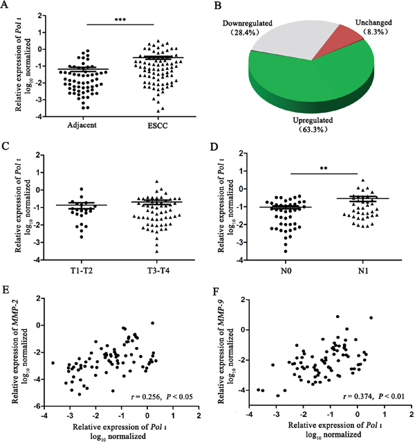 Pol &#x03B9; expression is frequently increased in human ESCC.