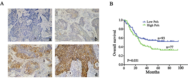 Pol &#x03B9; expression correlates with poor prognosis in human ESCC.