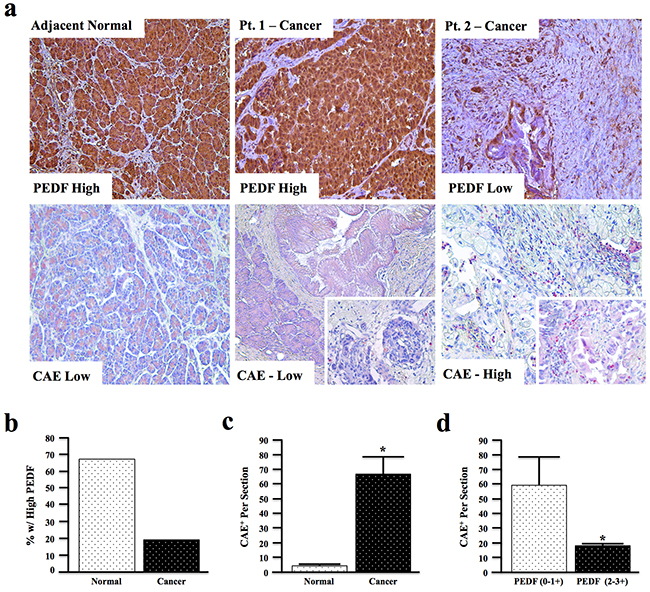 PEDF expression is decreased in human pancreatic cancer and inversely correlates with tissue inflammatory profile.